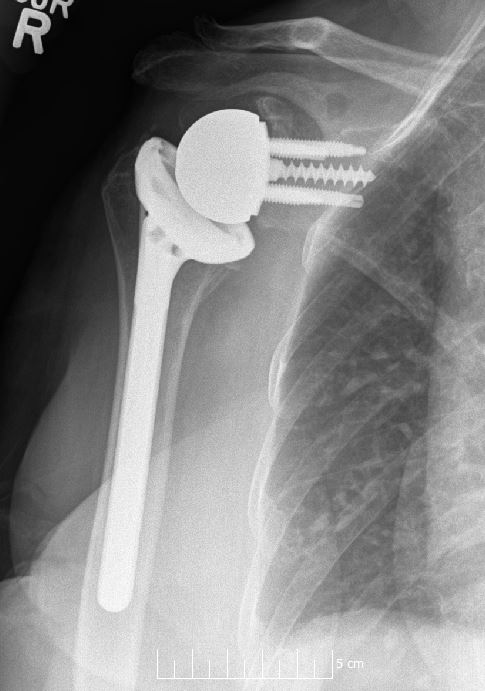 Shoulder Elbow iSAWE 6, postoperative radiograph