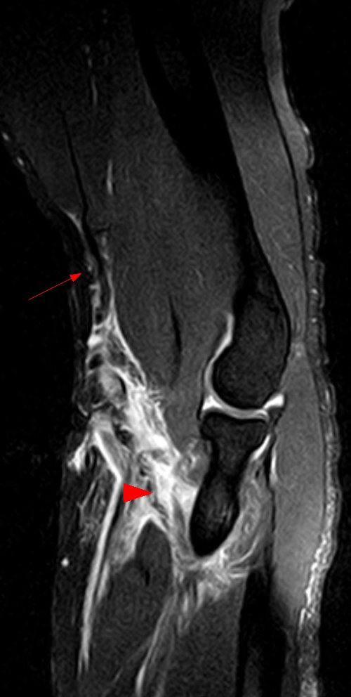 Shoulder Elbow iSAWE 8, sagittal mri of the elbow