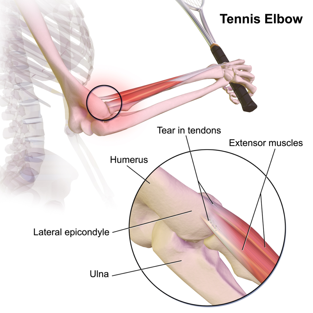 Shoulder Elbow iSAWE 9, illustration of the lateral elbow