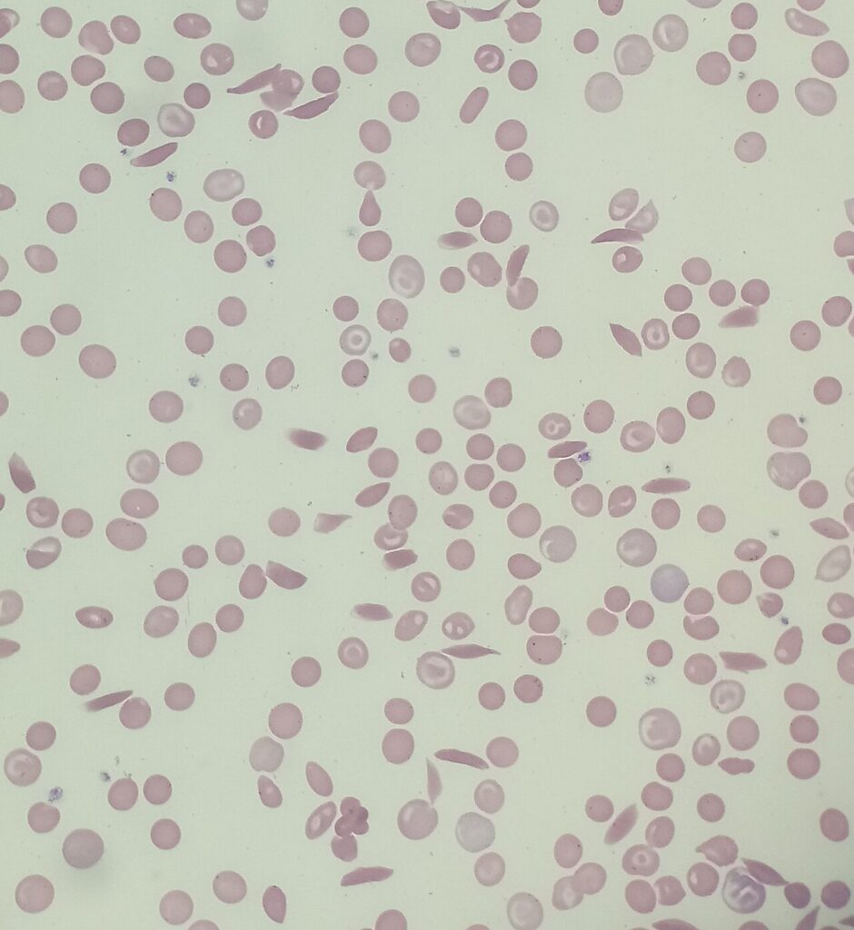 Sickle Cell Disease, blood smear showing sickled red cells in sickle cell anaemia