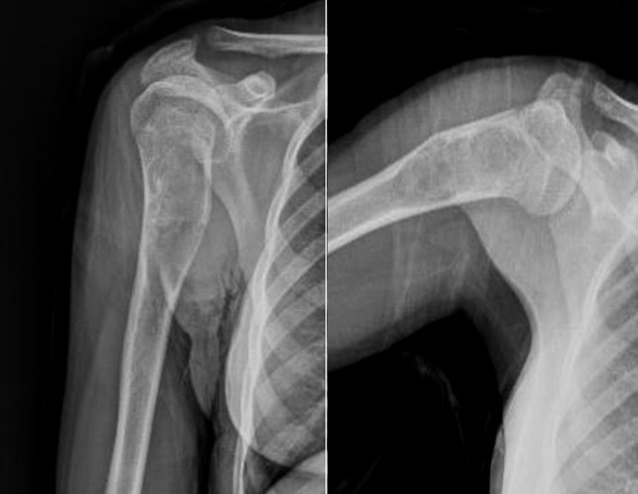 Simple Bone Cyst, radiograph of a simple (unicameral) bone cyst