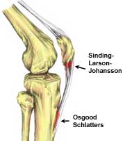 Sinding-Larsen-Johansson Disease, sites of osgood-schlatter and sinding-larsen-johansson disease