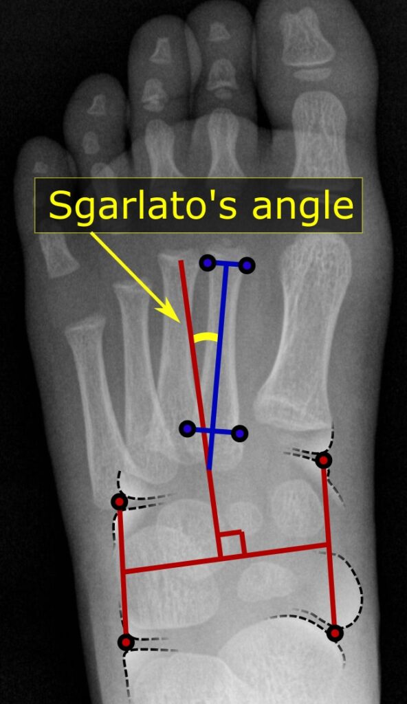 Skewfoot, radiograph showing measurement of metatarsus adductus with sgarlato’s angle