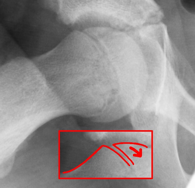 Slipped Upper Femoral Epiphysis | SUFE, radiograph of a slipped capital femoral epiphysis