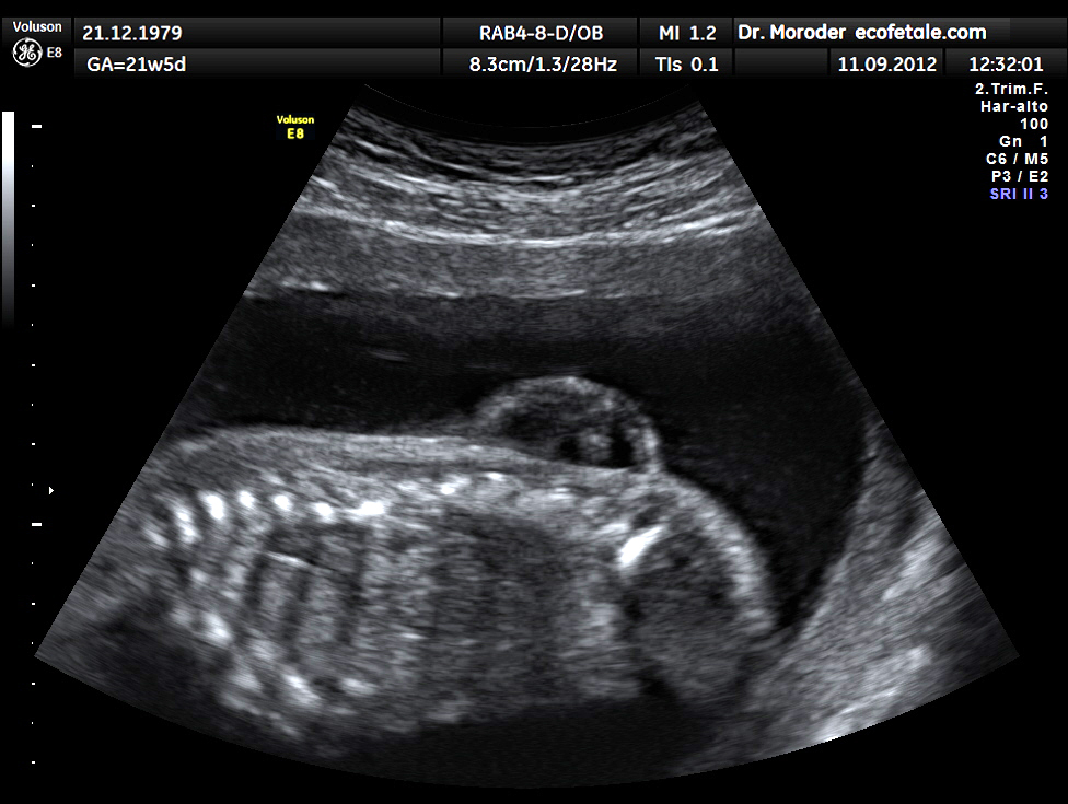 Spina Bifida, sagittal antenatal ultrasound of a lumbar spina bifida