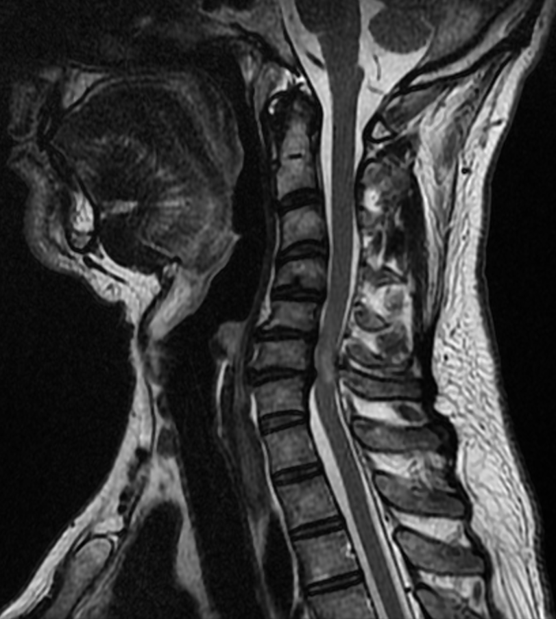 Spine iSAWE 1, sagittal t2 mri of the cervical spine