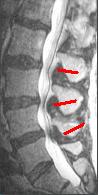Spine iSAWE 2, sagittal t2 mri of the lumbar spine