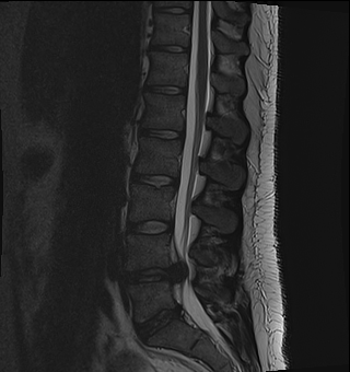 Spine iSAWE 3, sagittal t2 mri of the lumbar spine