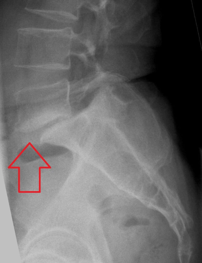 Spine iSAWE 4, lateral radiograph of the lumbosacral spine
