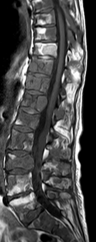 Spine iSAWE 6, sagittal t1 weighted mri of the spine