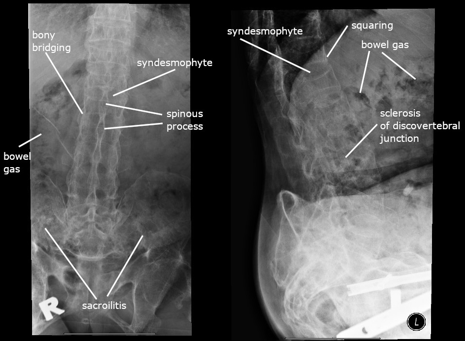 Spine iSAWE 7, radiographs of the lumbosacral spine in this patient’s condition