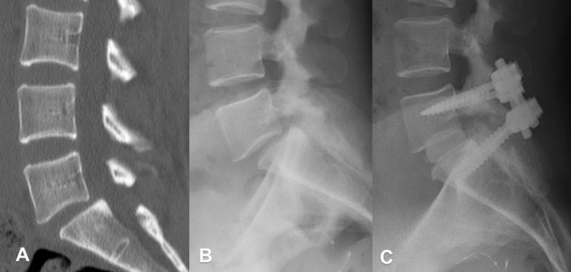 Spondylolysis & Spondylolisthesis, ct and radiograph of spondylolisthesis