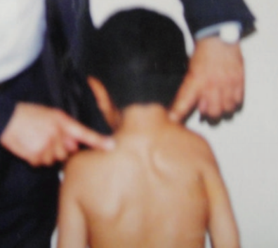 Paeds Elective iSAWE 18, clinical photograph of the back