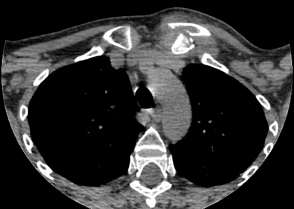 Shoulder Elbow iSAWE 19, axial CT of the chest