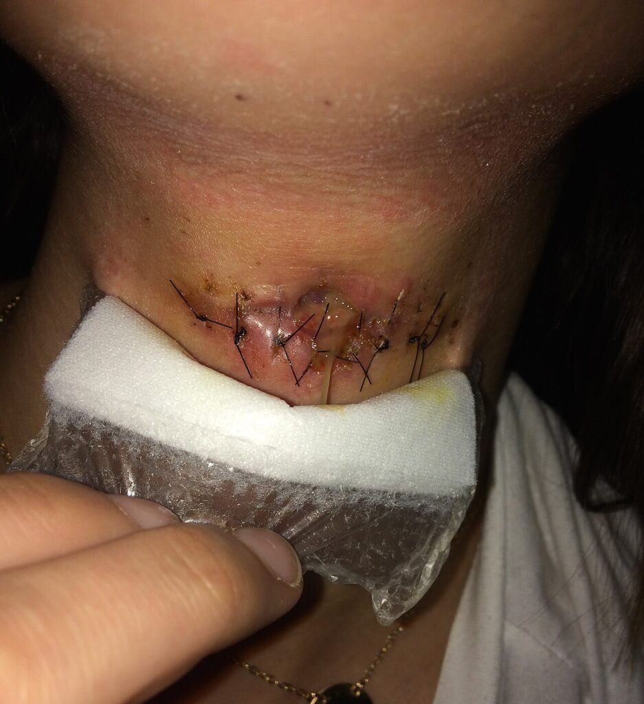 Surgical Site Infection, surgical site infection