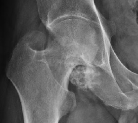 Hip iSAWE 16, AP radiograph of the hip