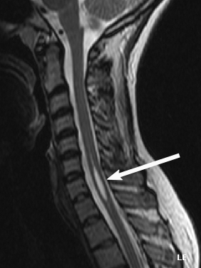 Spine iSAWE 20, sagittal MRI of the cervical spine