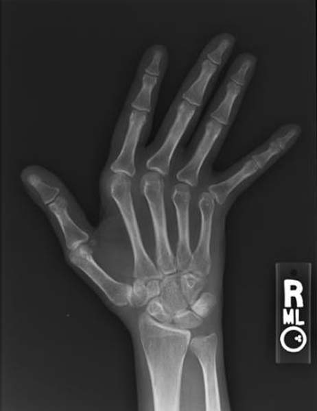 Systemic Lupus Erythematosus, hand radiograph of jaccoud arthropathy in systemic lupus erythematosus