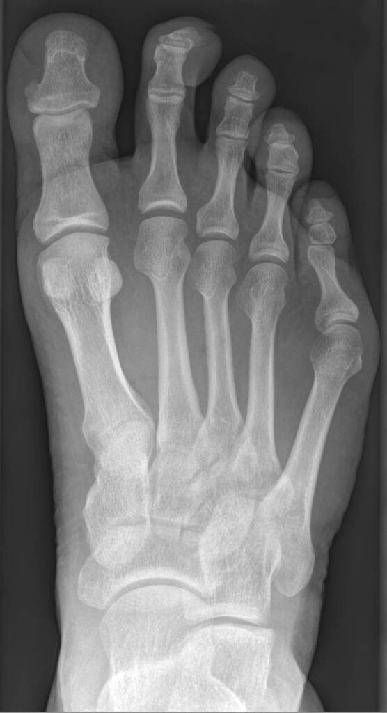 Tailor Bunionette, radiograph of a tailor’s bunionette