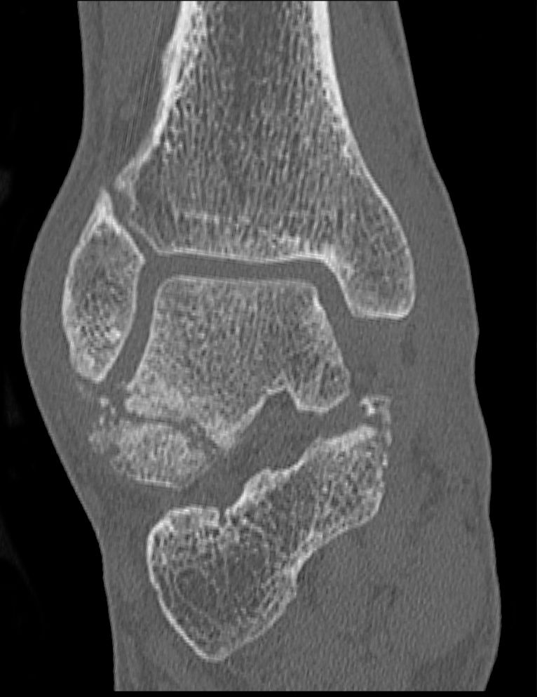 Foot Ankle iSAWE 14, coronal CT of the ankle