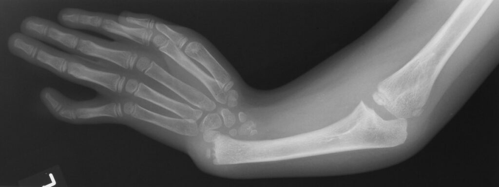 TAR | Thrombocytopenia with Absent Radius, radiograph of the forearm showing an absent radius and radially deviated hand in thrombocytopenia absent radius syndrome