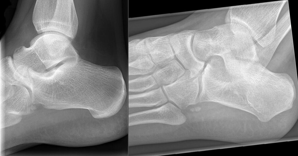 Tarsal Coalition, radiograph of a calcaneonavicular coalition