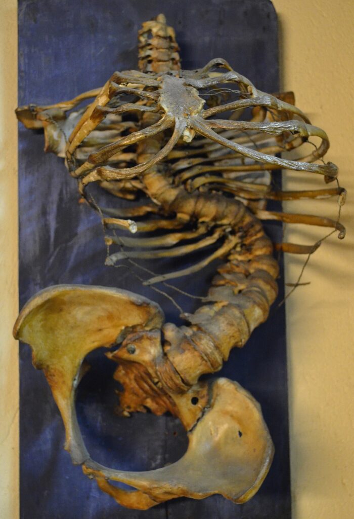 TB, museum specimen of pott disease of the spine
