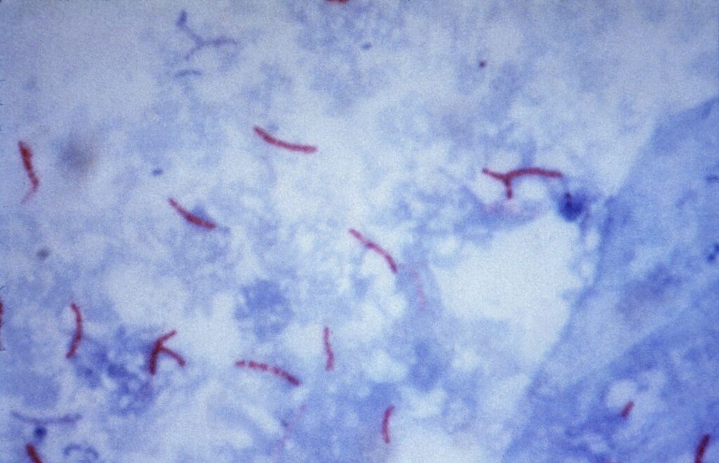TB, mycobacterium tuberculosis on ziehl-neelsen stain