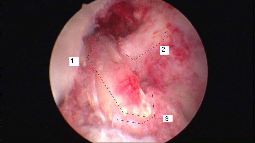 Technique for Anterior Approach THR, arthroscopic view during anterior cruciate ligament reconstruction