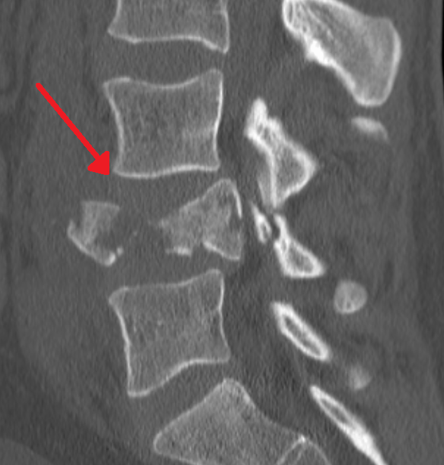 Thoracic & Lumbosacral Trauma | Fractures, sagittal ct of an l4 burst fracture