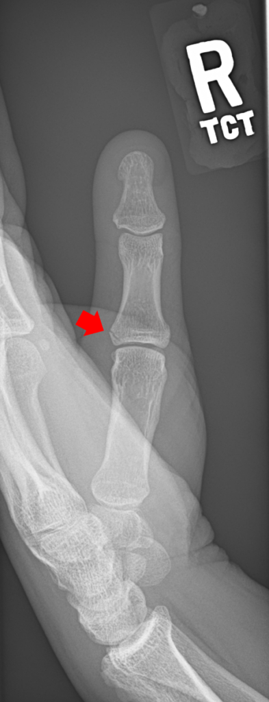 Thumb Ulnar Collateral Ligament Repair, ulnar collateral ligament injury of the thumb (skier’s thumb)