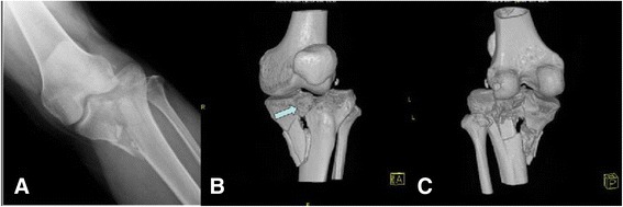 Paeds Trauma iSAWE 13, radiograph and CT of the knee