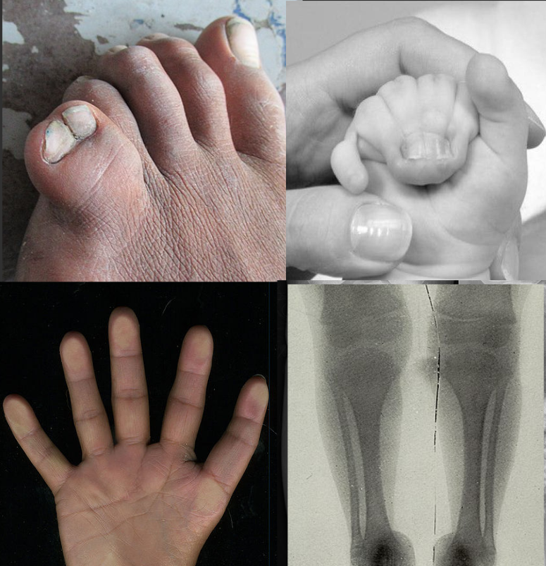 Tibial Hemimelia, clinical photographs and radiograph in tibial hemimelia with polysyndactyly