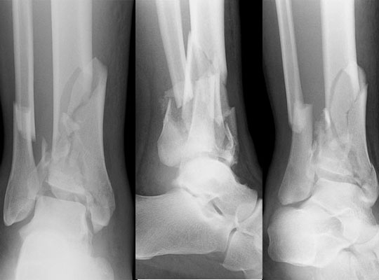 Tibial Pilon Fractures, radiograph of a pilon fracture