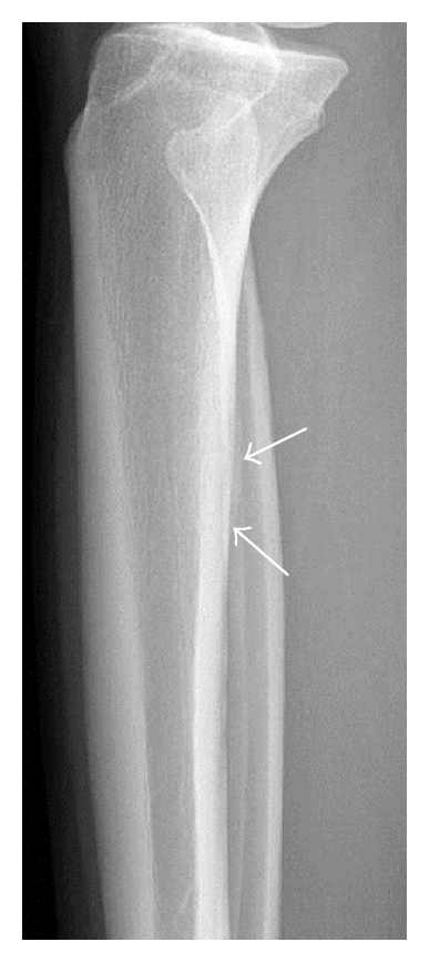 Stress Fracture of the Proximal Tibia, radiograph of the tibia showing subtle periosteal reaction at a stress fracture