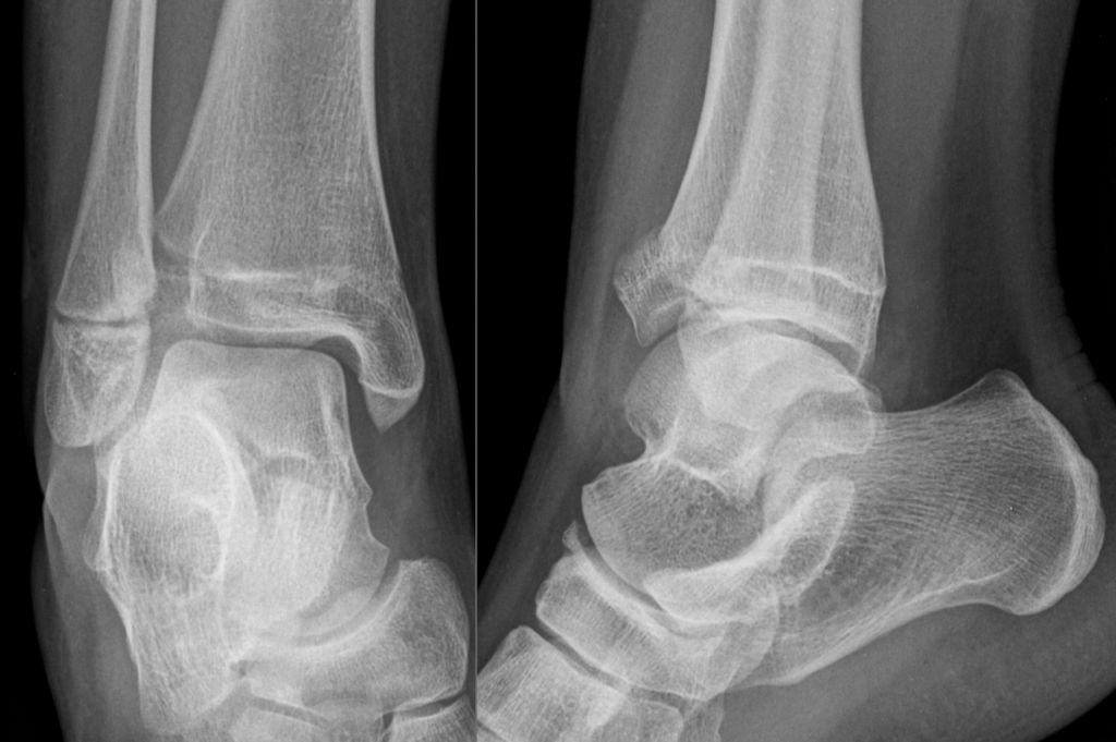Paeds Trauma iSAWE 10, radiographs of the ankle