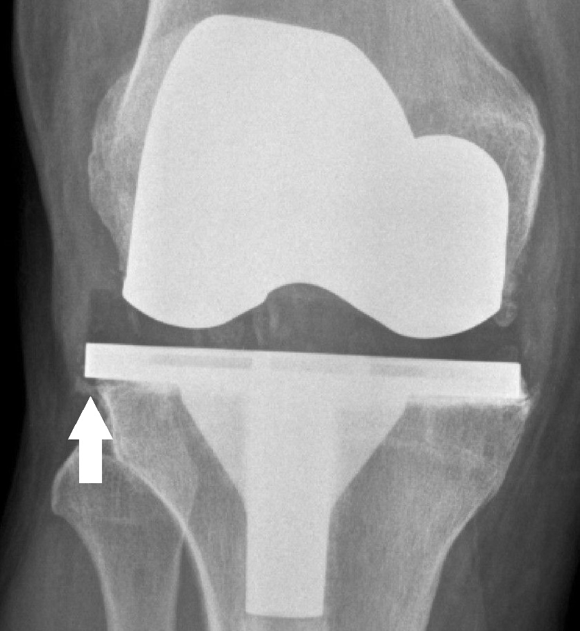 Arthroplasty iSAWE 9, AP radiograph of a total knee arthroplasty