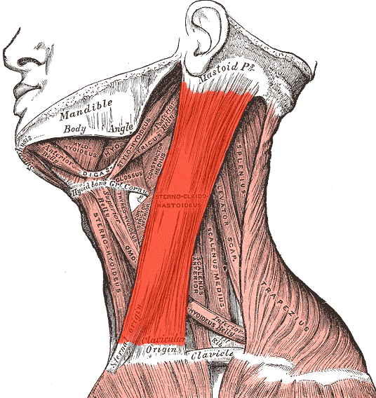 Torticollis, sternocleidomastoid