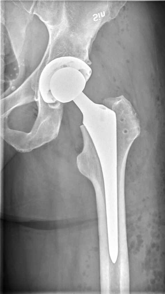 Total Hip Replacements - Leg Length & Stability, anteroposterior radiograph of a total hip arthroplasty