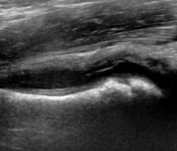 Transient Synovitis of the Hip, ultrasound showing a hip joint effusion in transient synovitis