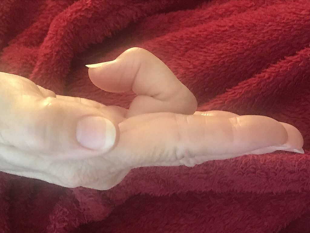 Hand iSAWE 11, clinical photograph of the hand