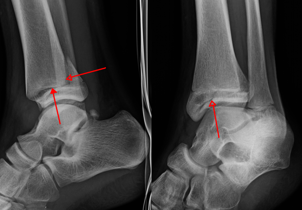 Triplane Fractures, radiographs of a triplane fracture of the distal tibia