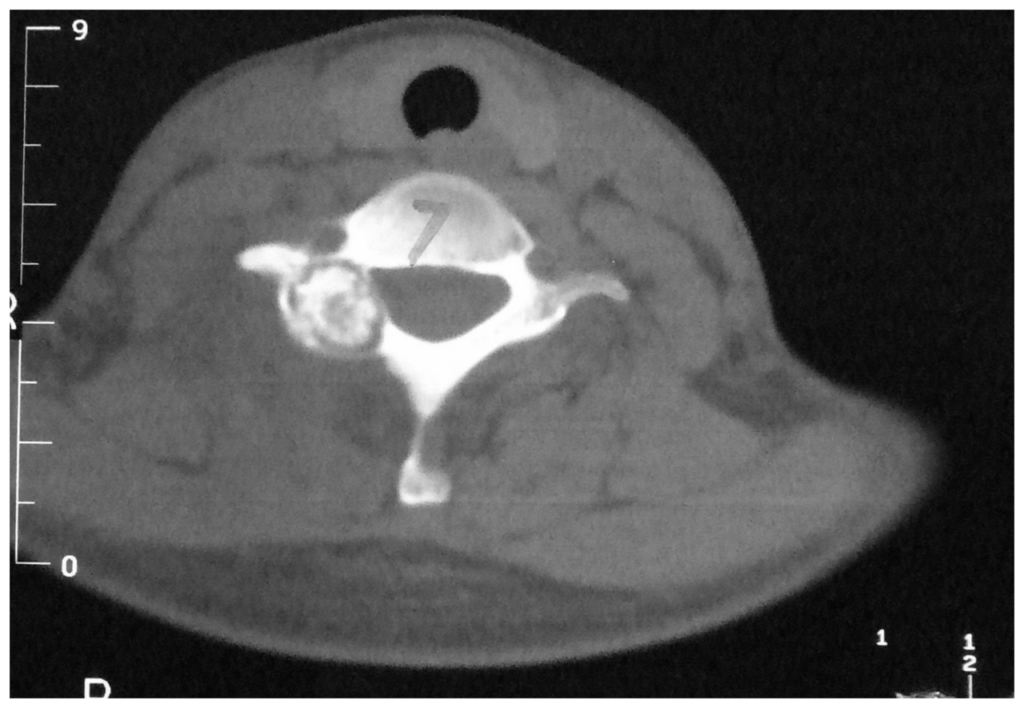 Axial CT of an osteoblastoma of the C7 vertebra