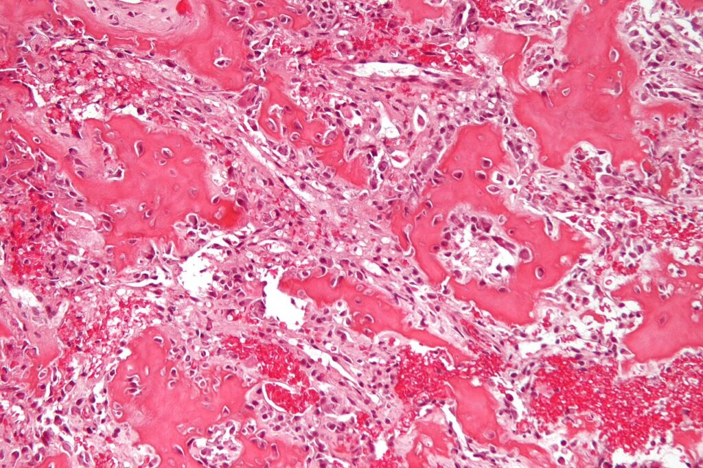 Histology of an osteoid osteoma nidus showing osteoid trabeculae and osteoblasts