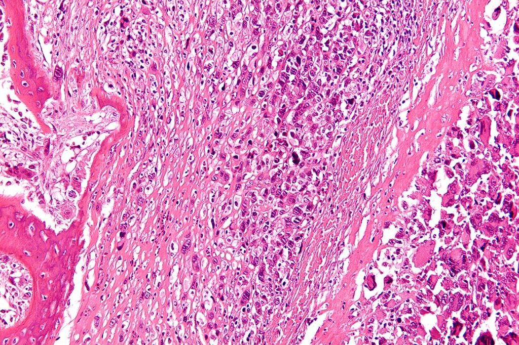 Histology of osteosarcoma showing malignant cells producing osteoid