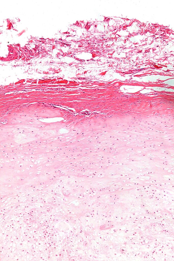 Histology of an enchondroma showing lobules of hyaline cartilage