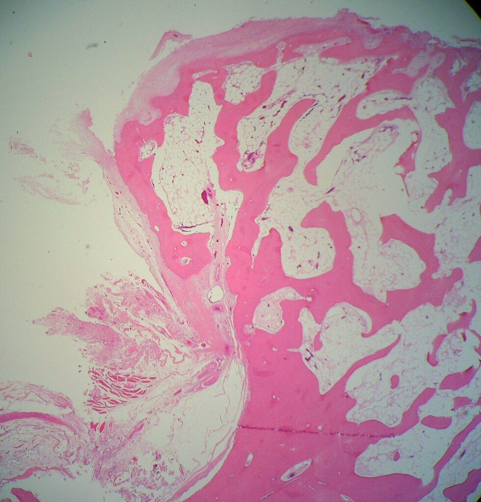 Histology of an osteochondroma showing the cartilage cap over cancellous bone