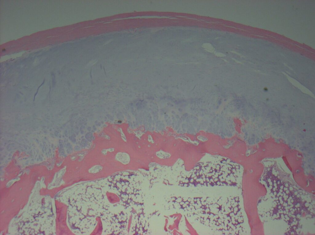 Histology of an osteochondroma, which epiphyseal osteochondroma resembles