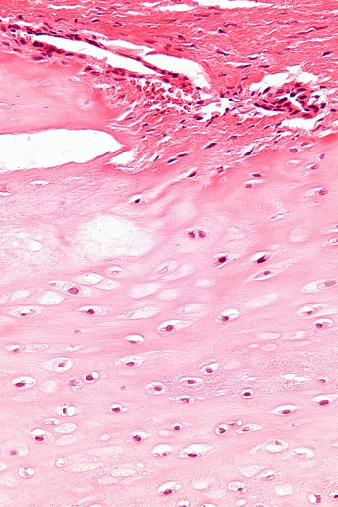 Histology of a chondroma showing hyaline cartilage