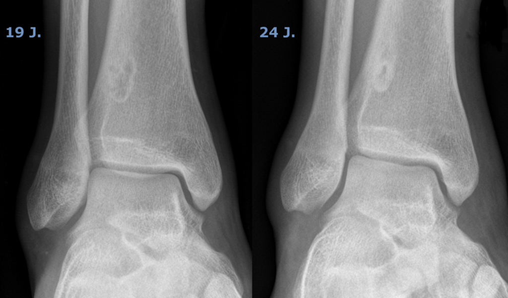 Serial radiographs of a fibrous cortical defect of the distal tibia